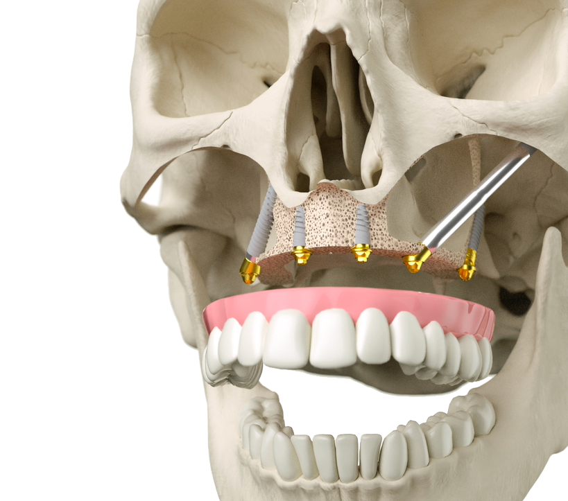 Maxilla-for-all - Treatment Concept - Jdentalcare