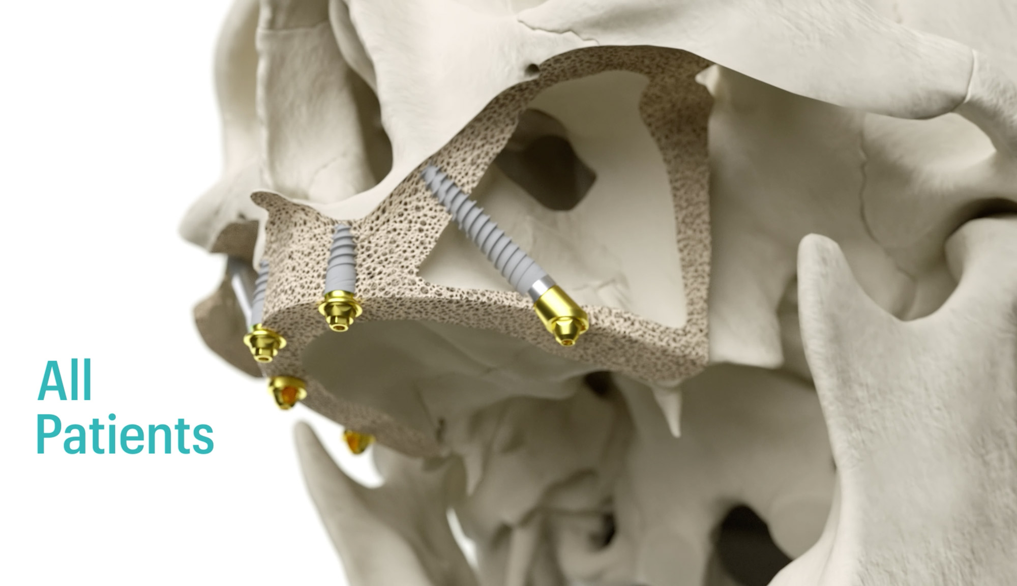 MAXILLA-FOR-ALL® - JDentalCare