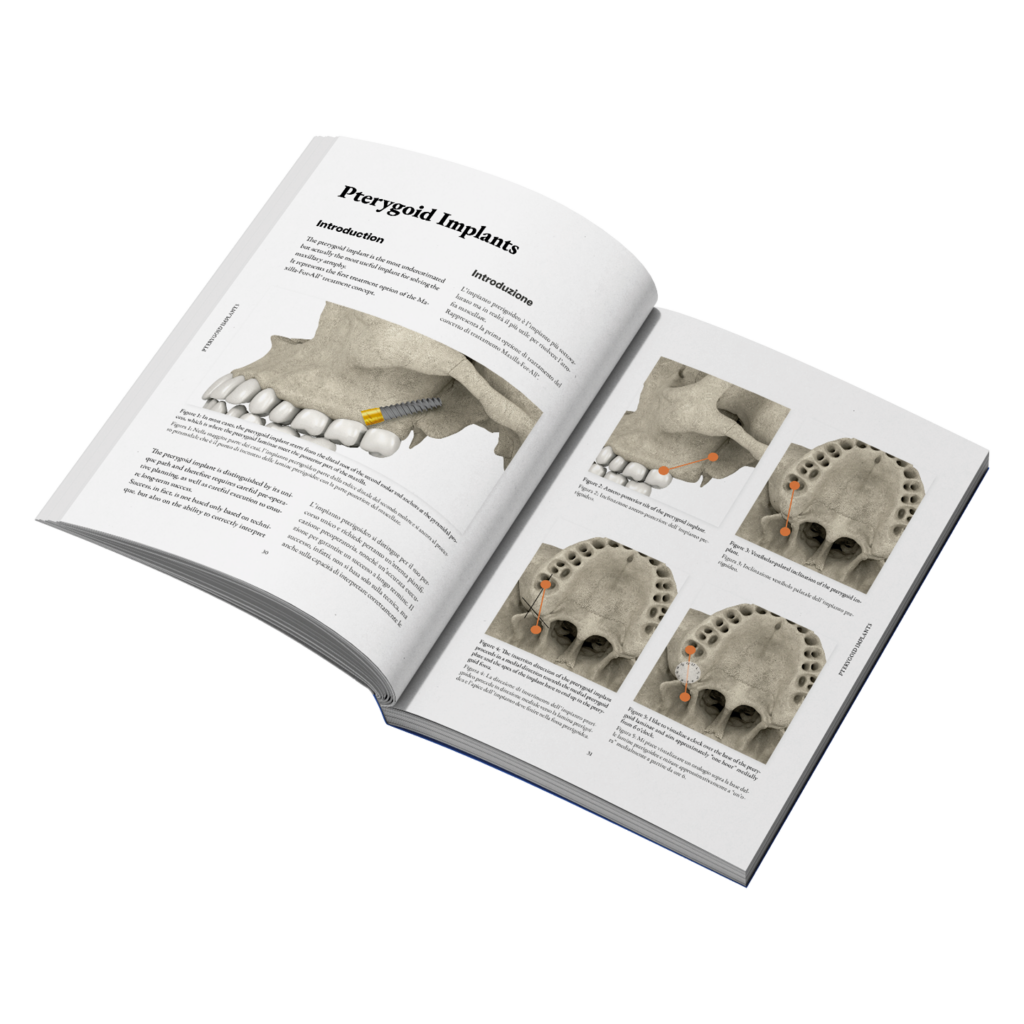 Become an expert in Maxilla-For-All® with the new book by Dr