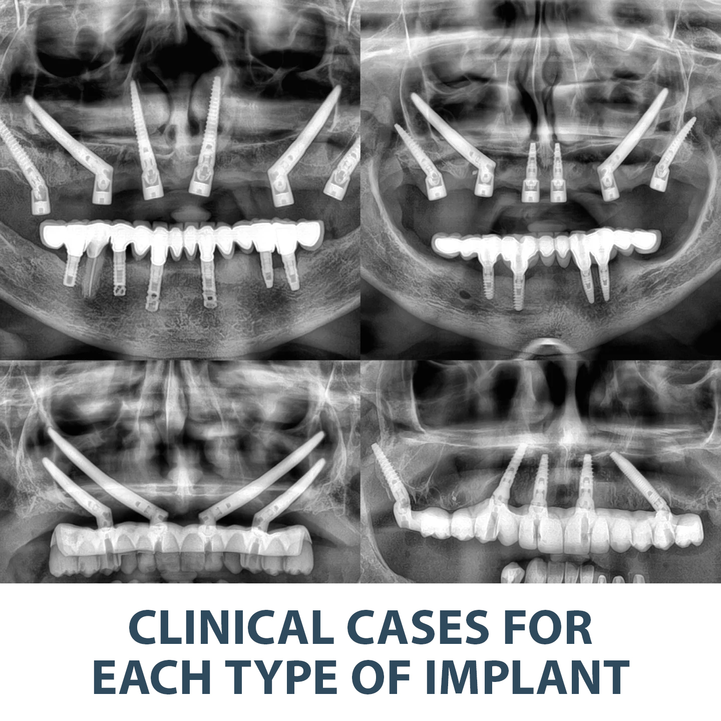 Become an expert in Maxilla-For-All® with the new book by Dr