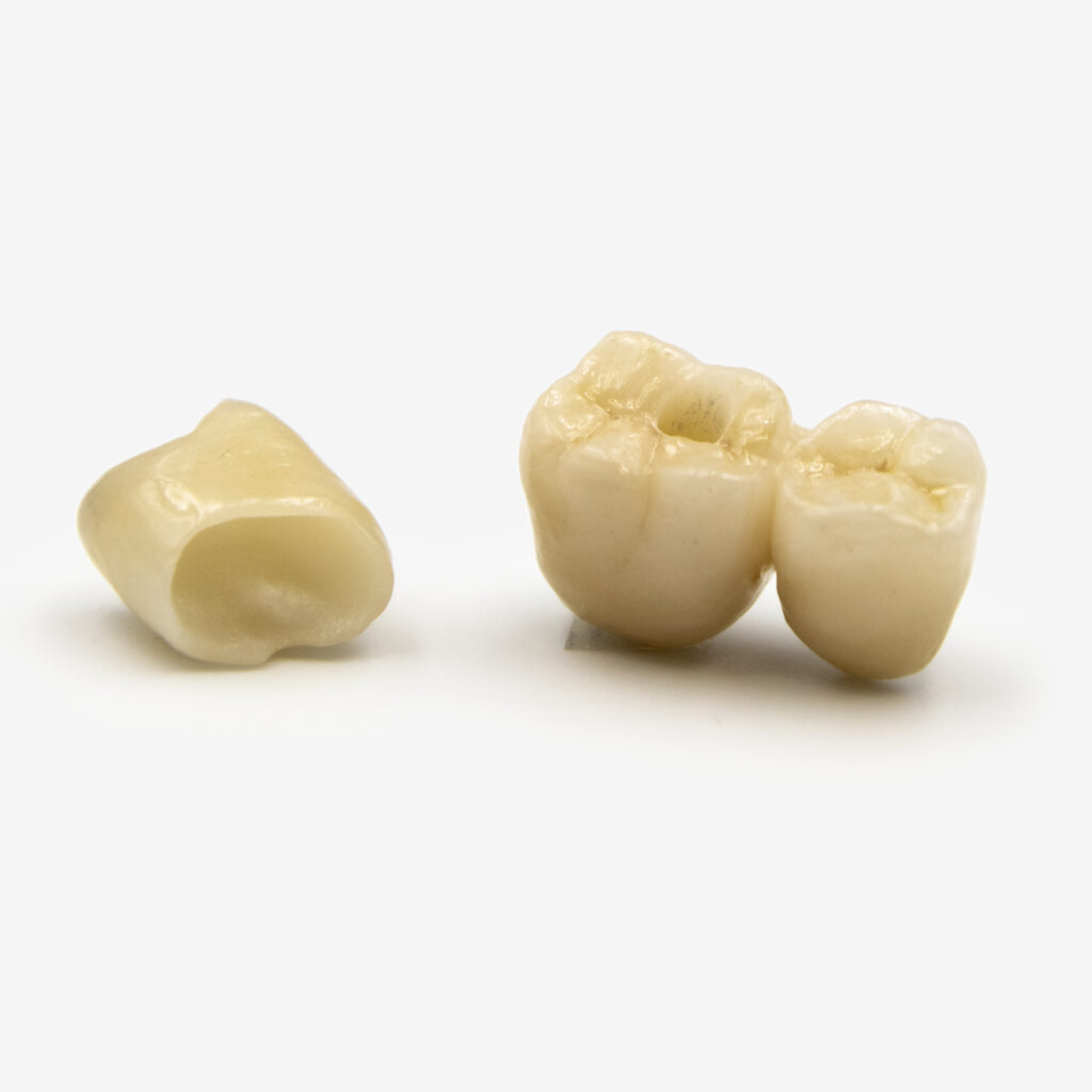 Corona o ponte su dente naturale