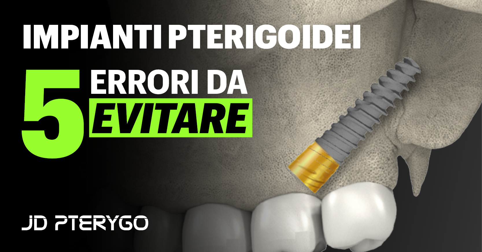 Impianti pterigoidei: 5 errori chirurgici da evitare