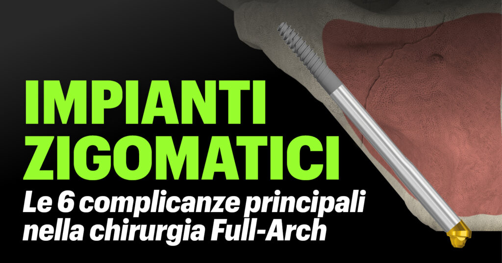 Le 6 principali complicanze nella chirurgia Full-Arch con impianti zigomatici e come prevenirle