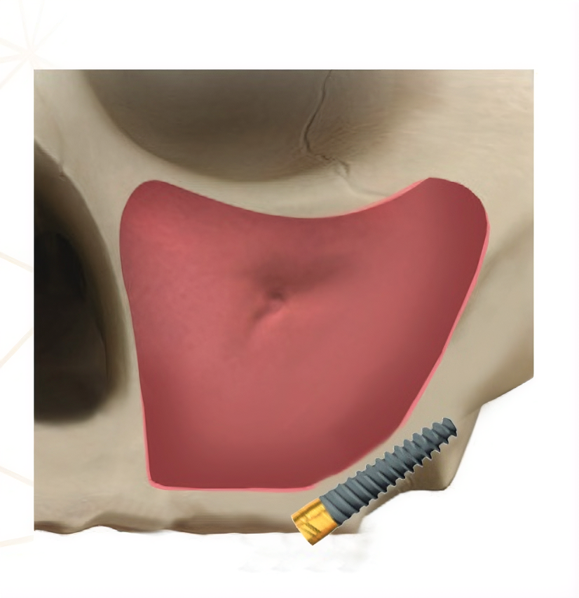 Impianto Dentale. Impianti Pterigoidei